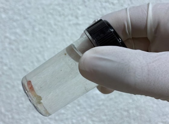 Biopsia de médula ósea (BAMO)